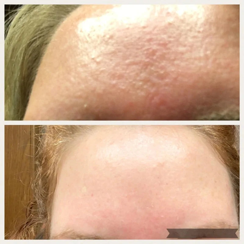 AHA 30% + BHA 2% Face Peeling Solution