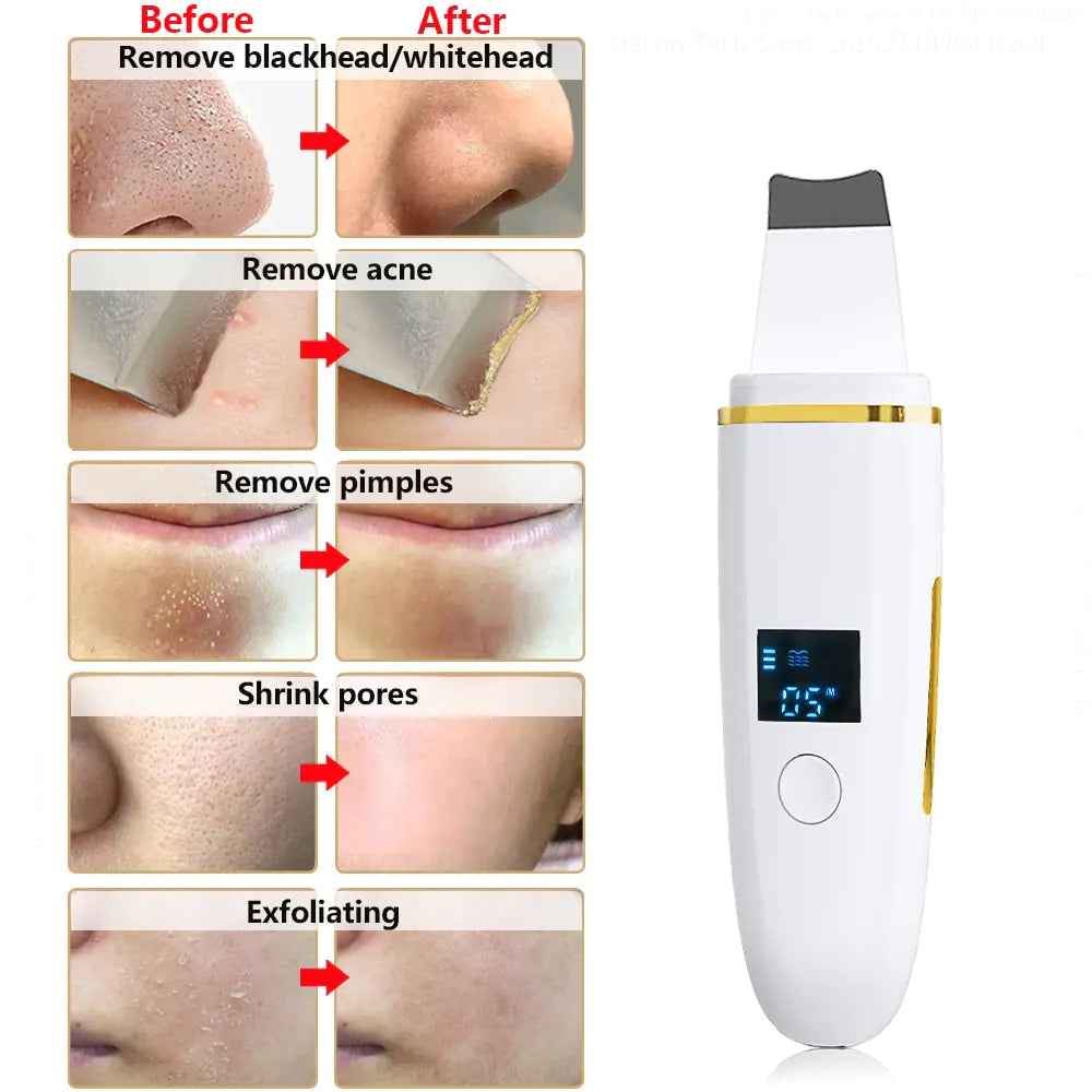 Facial Cleansing Ultrasonic Skin Scrubber