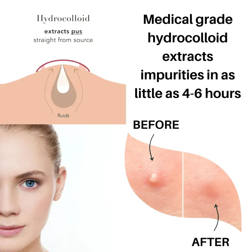 Hydrocolloid Acne Pimple Patches